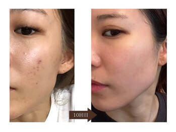 アイル 江坂店(iru)/ハーブピーリング10回目