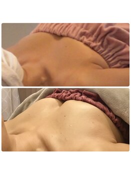 サチ(Sachi)/急激なダイエットで下垂しました