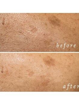 ルマエクレ(rmaecla)/毛穴ケア カーボキシー