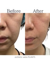 プランツ(PLANTS)/30代／２回／ほうれい線たるみ
