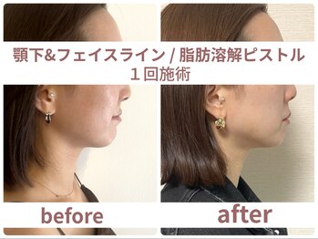 サボラミ(sabor A Mi)/小顔溶解ピストル 液剤1.5倍量