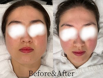 トウキョウビューティーラボ(TOKYO BEAUTY LABO.)/小顔マッサージBefore&Afer