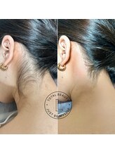 ブラジリアンワックス脱毛サロン ルラ 恵比寿(Lula)/うなじワックス/Before &after