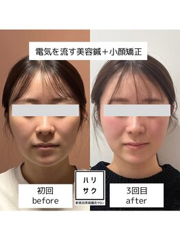 ハリサク/継続施術