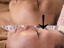 サロン ドロップ 上小田井(Salon drop)/「シミ改善」