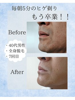 ポーベル(Peau belle)/ヒゲ脱毛　Before→After 