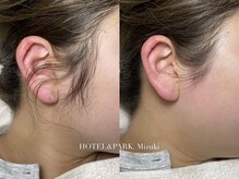 ホテルアンドパーク(HOTEL&PARK.)/もみあげワックス脱毛