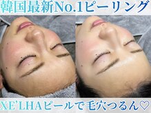 オンダム 南青山 表参道(ONDAM)の雰囲気（LHAピーリング進化版セラピール！美容乳酸菌プラスで毛穴つるん）