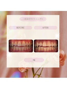 プラスビーセルフ(+b self)/ホワイトニングビフォーアフター