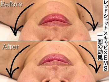 エトワール(etoile)/REDSHOT×ラジオ波×キャビ×EMS