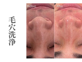 エトレ(etre)/毛穴/黒ずみ/毛穴洗浄/エステ