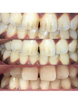 メンズ脱毛 リボーン(reborn)/セルフホワイトニング効果