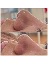 アイリーン(IRENE)/毛穴洗浄の効果実感♪