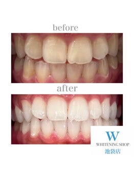 ホワイトニングショップ 池袋店/【ビフォーアフター】美白
