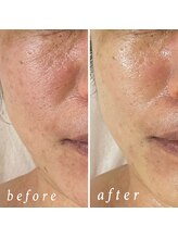 ルマエクレ(rmaecla)/肌質改善ラミネーションピール　