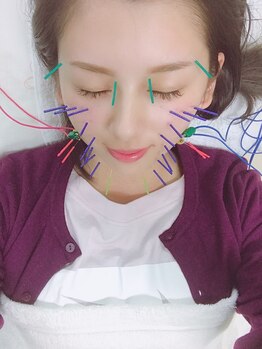 みずわき治療院/美容鍼(電気を流します)