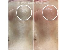 ピエル 北千住店(PIEL)/毛穴エクストラクションの効果