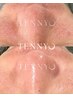 脱いちご鼻【TENNYO肌育毛穴集中ケアコース】￥7900