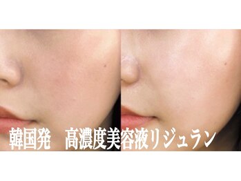 美的アヴェニール(美的.Avenir)の写真/《最強プラズマ》　高濃度美白美容液導入！
肌のキメ、ハリ、ツヤ、トーンアップ即実感☆