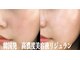 美的アヴェニール(美的.Avenir)の写真/《最強プラズマ》　高濃度美白美容液導入！
肌のキメ、ハリ、ツヤ、トーンアップ即実感☆