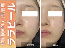 ブレア(Blair)/ララピール