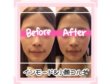 サロン ド シャーロット 恵比寿の雰囲気（韓国最新美容インモードリフト☆切らずに小顔＆リフトアップ↑）