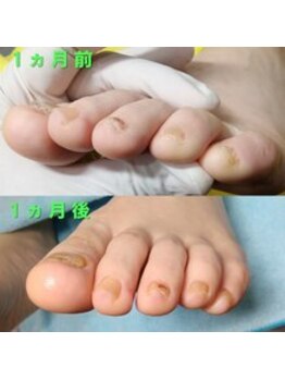 【肥厚・変形爪】ネイル/フット