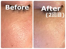 スイ 昭島店(Sui)/ハーブピーリング/毛穴/ツヤ肌