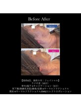 ドルチェビューティーサロン 戸塚安行店(Dolce Beauty Salon)/リフトアップFacial_施術4回
