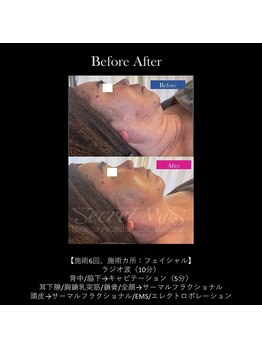 ドルチェビューティーサロン 戸塚安行店(Dolce Beauty Salon)/リフトアップFacial_施術4回