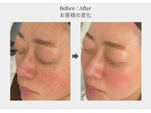 ベル 新橋(Belle)/ハーブピーリング×シミ赤み