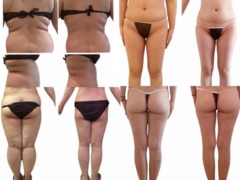 ルブラン(Lu'Bulan)の写真/【特許取得マシン×完全オーダーメイド施術☆結果重視で大幅減少】石垣島初導入★最新エンダモロジー設置店