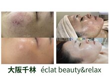 エクラ(eclat)