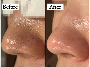 ルフレ 広島(Lufure)/毛穴ケア3回目のお客様★