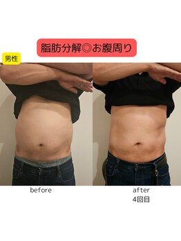 ウル バイ ラシック(Ulu by Lasic)/【脂肪分解】上半身ダイエット◎