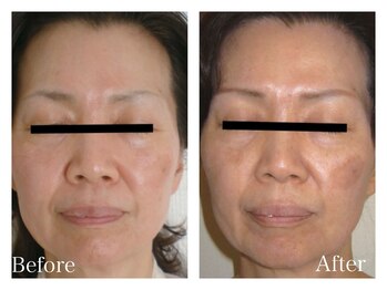 イヨヨ(iyoyo)/BeforeAfter