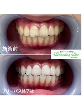ホワイトニングサロン 名古屋駅店/【ホワイトニング施術例】