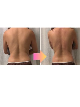 ケアラ(Care.A)/1回での変化