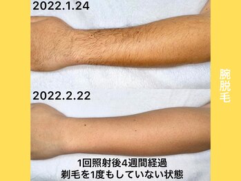 エクレ 柏店(EKURE)/腕脱毛