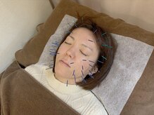 こじま 富雄団地接骨院/ベーシック美容鍼