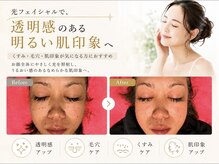 イン東京 青森浜田店/光フェイシャルBefore＆After