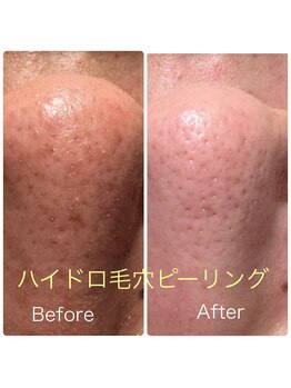 フェアリー 小松店の写真/紫外線を浴びて毛穴が開いていませんか？冬の乾燥ケア前にしっかり汚れ取り+潤い対策がマスト!!
