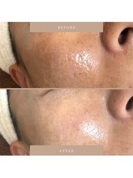 ブリス(Bliss)/ACトリートメント 