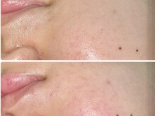 レネット サロン 立川店(Reinette Salon)/フェイスワックス