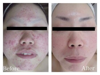 イヨヨ(iyoyo)/BeforeAfter