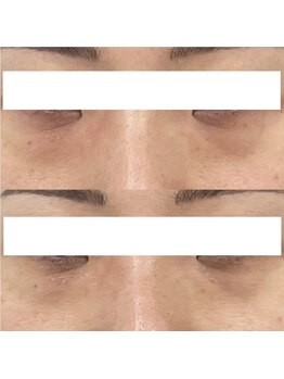 ヴェルシック(Belchic)/目の下のクマとたるみ両方改善