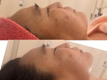 サロンドデュイ/1回施術/シミケア/四日市