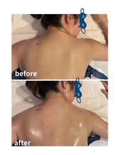 ウィッシュプロサロンケー(WISHpro salon K)/肩ケア　60分1回インディバ