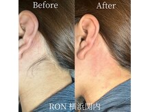 うなじのムダ毛脱毛でスッキリ綺麗な後ろ姿に！