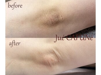 ジュエカフネ 広尾(JueCAFUNe)/《ルメラ》 肘メラニンケア症例